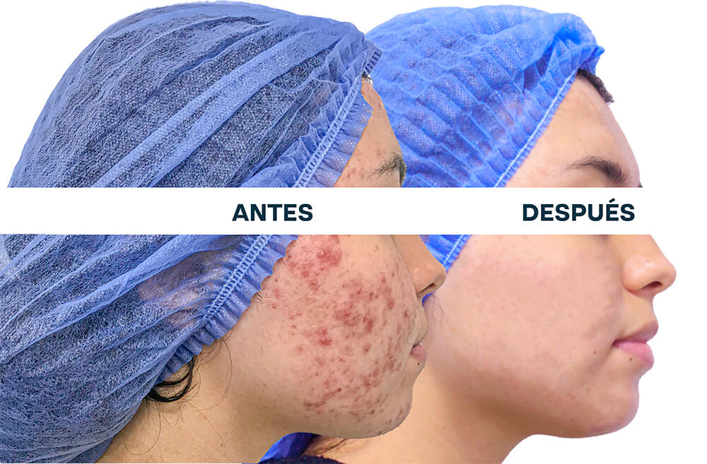 Clínica Láser de Acné